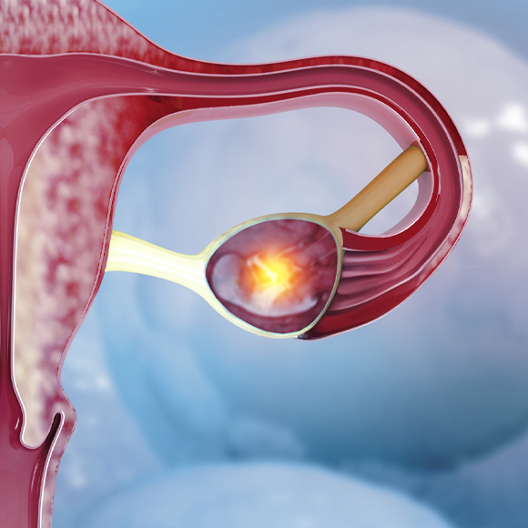 לידה בהפתעה