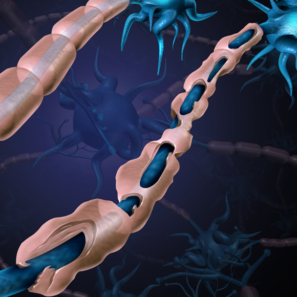 HIV נגד טרשת נפוצה