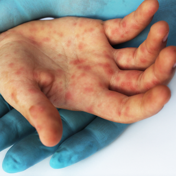 الحصبة في العالم