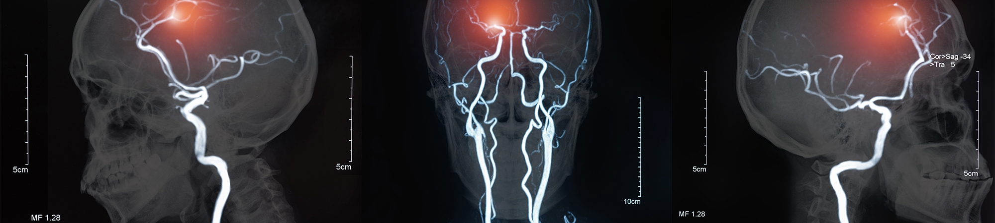 كلّ ما أردتم معرفته عن السّكتة الدّماغيّة