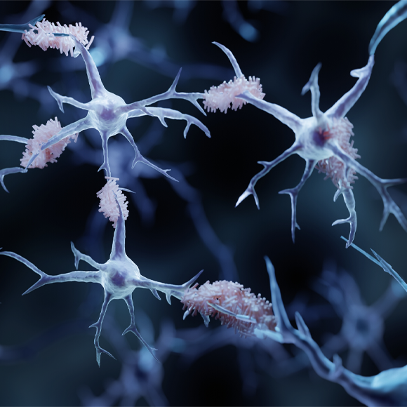 تثبيط تطوّر ألزهايمر في مراحله المبكّرة