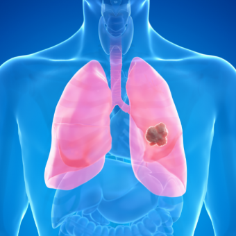 جزيء RNA ضدّ سرطان الرّئة
