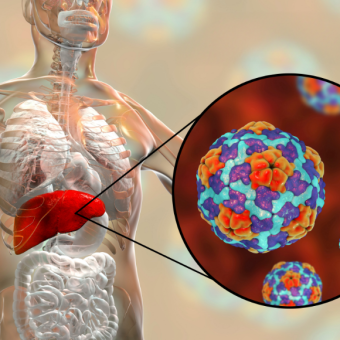 מחלות ללא גבולות: שחפת בגן ילדים