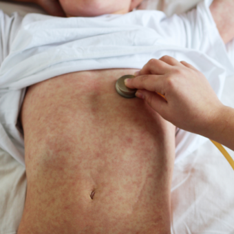 מחלות ללא גבולות: פריחת החצבת