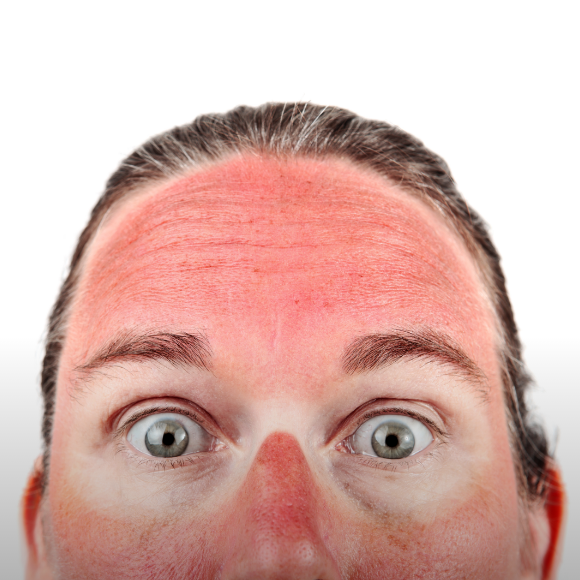 הסיבה המפתיעה לכוויות שמש