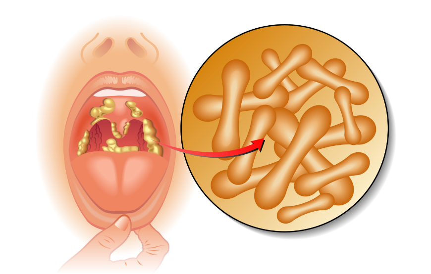 מחלה חיידקית מסוכנת שבעבר הייתה גורמת למוות המוני של ילדים. קרום הנוצר על גבי רקמת הגרון והלוע בדיפתריה לצד החיידק מחולל המחלה | rob9000, Shutterstock