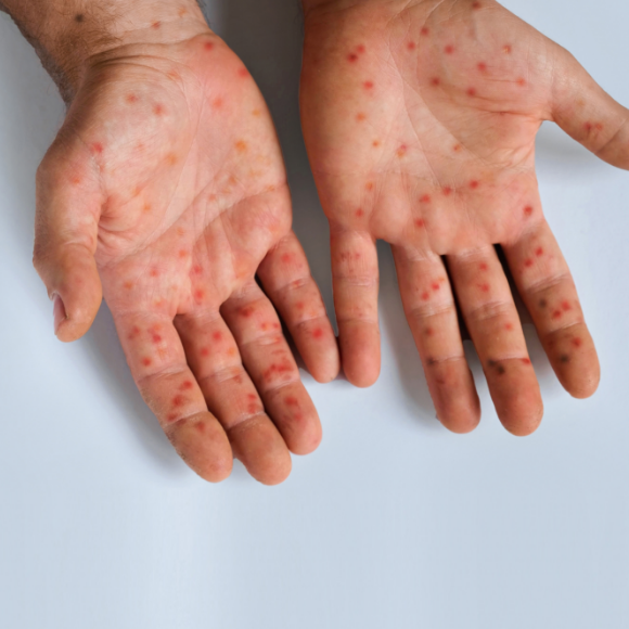 מחלות ללא גבולות: אבעבועות הקוף בילדים