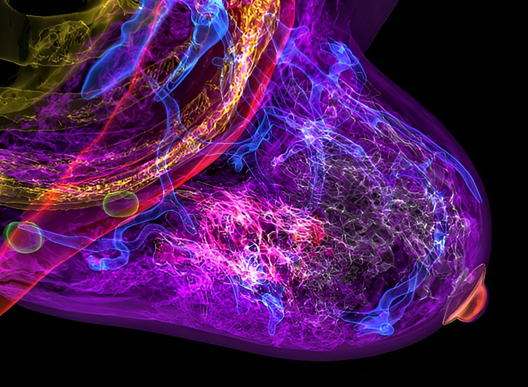 הלאסי חלתה בפעם השנייה בסרטן השד בשנת 2020, כשהייתה בת כחמישים. סריקה של שד עם סרטן | K H Fung / Science Photo Library