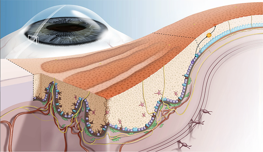 חסר בתאי גזע הפוגע ביכולת של הקרנית להתחדש. מבנה האזור הפגוע בקרנית במחלת LSCD | מקור: Shiding et al., 2024
