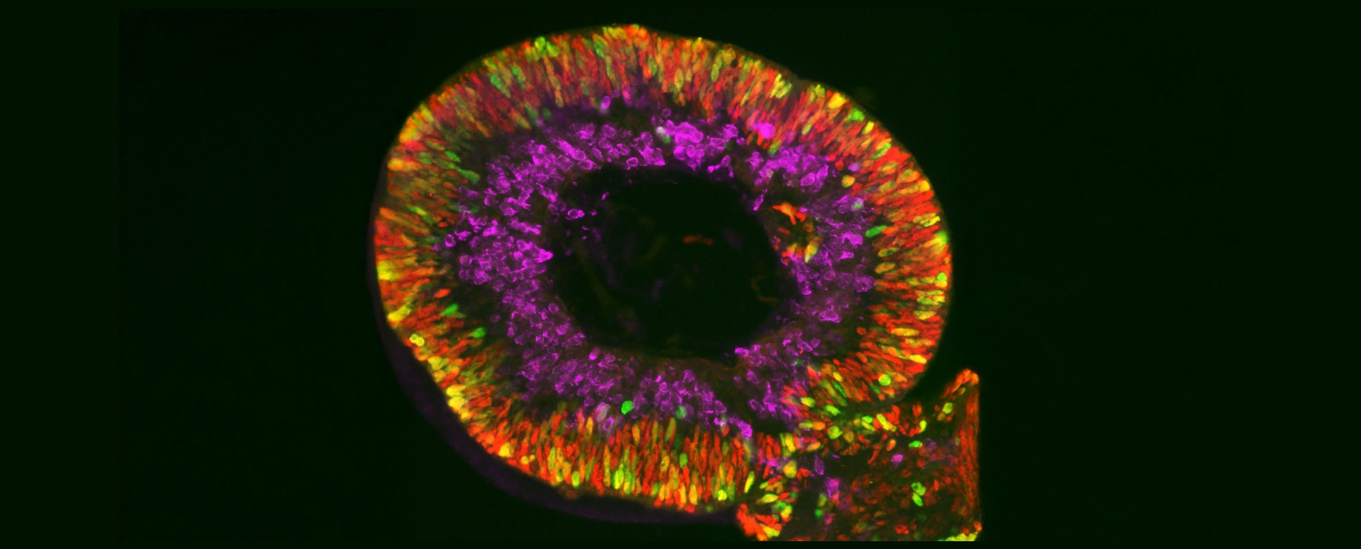 الخلايا الجذعيّة لعلاج حالات فقدان البصر