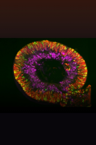 الخلايا الجذعيّة لعلاج حالات فقدان البصر