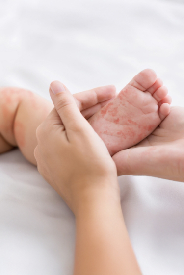 הקורונה חוזרת, החצבת נשארת: מחלות ללא גבולות