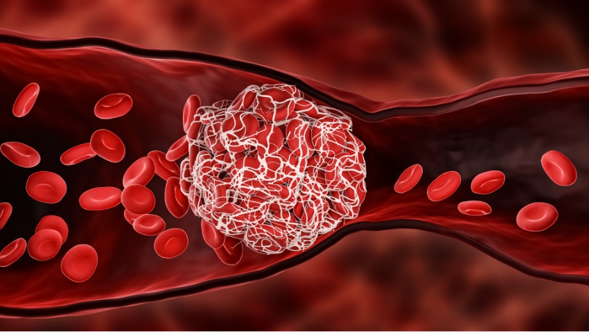 המחקר החדש גילה שצריכת אריתריטול העלתה משמעותית מדדים שמעידים על קרישת דם מוגברת. קריש דם חוסם כלי דם | MattL_Images, Shutterstock