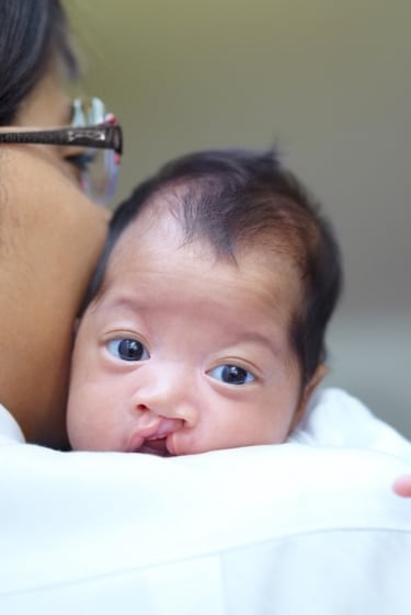 התגלה גורם אפשרי לשפה ולחך שסועים