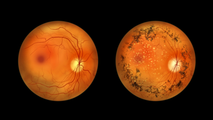 החוקרים השתילו את תאי הגזע ברשתית פגועה של עכברים עם מוטציה למחלת רטיניטיס פיגמנטוזה, הגורמת לעיוורון אצל בני אדם. רשתית עם רטיניטיס פיגמנטוזה (ימין) ורשתית בריאה (שמאל) | Kateryna Kon, Shutterstock