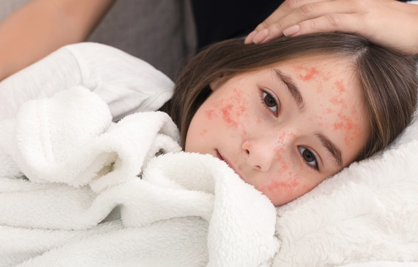 חצבת היא המחלה הנגיפית המדבקת ביותר הידועה לנו, ואף עלולה לסכן חיים. ילדה חולה בחצבת | Shutterstock, Prostock-studio