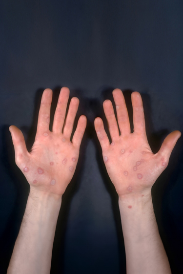 תרופה ניסיונית לנשילת עור חריפה