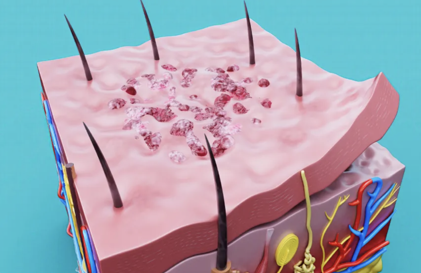 נשילת עור חריפה מתאפיינת בהתקלפות של העור עד כדי התנתקות מלאה שלו ובהופעת שלפוחיות על פני 30 אחוז ויותר משטח הגוף. נגע והתנתקות שכבת העור העליונה | Julien Tromeur / Science Photo Library