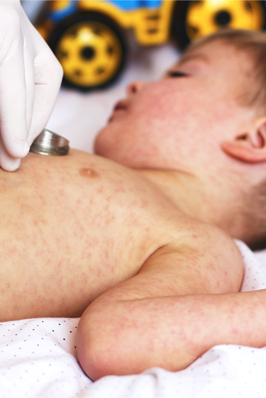 מחלות ללא גבולות: בארץ ובעולם, החצבת לא עוצרת