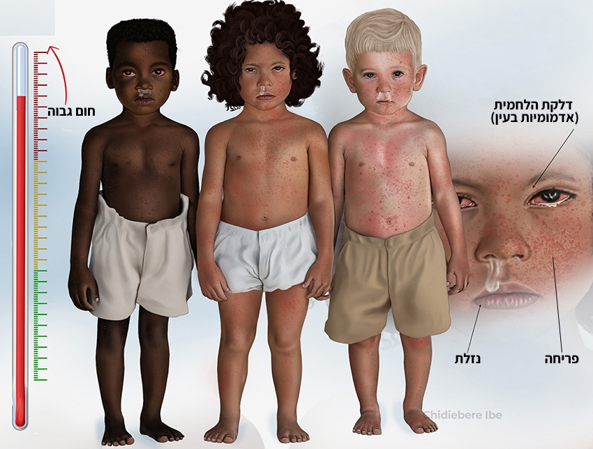 שני פעוטות עדיין מאושפזים במחלקת טיפול נמרץ, כשהם מחוברים למכשיר אקמו המחליף את פעולת הלב והריאות שנפגעו בגלל מחלתם. ילדים עם תסמיני חצבת | Chidiebere Ibe, Wikimedia