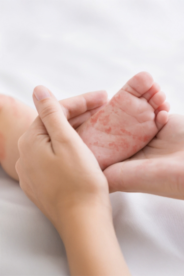 מחלות ללא גבולות: החצבת הורגת, הקורונה מתפשטת