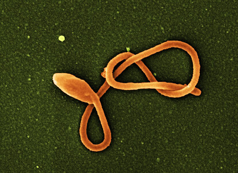 אישה הרה עם תסמיני אבולה אושפזה ומתה בתוך שעות לאחר שמערכות גופה קרסו. נגיף אבולה במיקרוסקופ אלקטרונים | Niaid / National Institutes Of Health / Science Photo Library