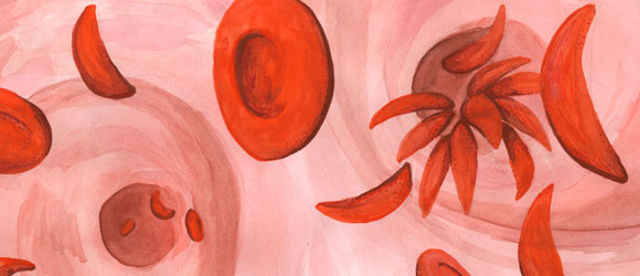 תאים אדומים באנמיה חרמשית | איור: Science Photo Library