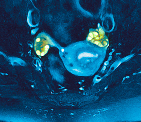 שחלות פוליצסטיות (בירוק) בסריקת MRI | מקור: GUSTOIMAGES / SCIENCE PHOTO LIBRARY