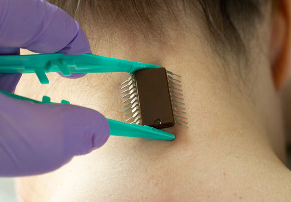 אילוסטרציה של שבב להשתלה | Shutterstock, ToKa74