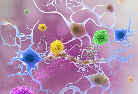 תאי מערכת החיסון (אדום, צהוב, ירוק), פוגעים במעטפת המיאלין (חום) של שלוחות תאי העצב | איור: HOARAU HUGUES DOMINIQUE / BSIP / SCIENCE PHOTO LIBRARY