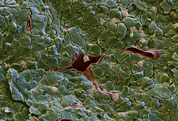 תאי דם לבנים (בלבן) שחדרו לגידול סרטני. צילום במיקרוסקופ אלקטרונים סורק | צילום: Eye of Science / Science Photo Library