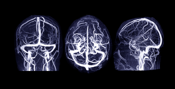 תמונה ברורה של הוורידים במוח בסריקת MRI | צילום: samunella, Shutterstock