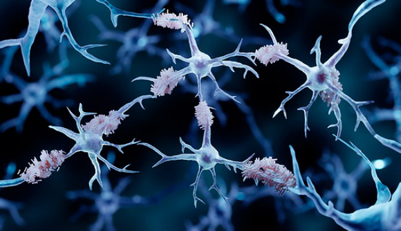 משקעי עמילואיד בטא במוח | איור: ARTUR PLAWGO / SCIENCE PHOTO LIBRARY