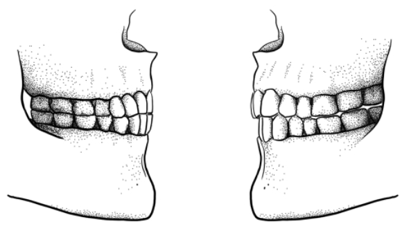 השינוי במיקום השיניים - לסתות במבצב אובר-בייט (מימין), לעומת לסתות בקו אחד | איור: Tímea Bodogán, University of Zurich
