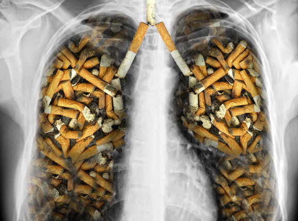 צילום ריאות ברנטגן מכוסה סיגריות | איור: Protasov AN, Shutterstock