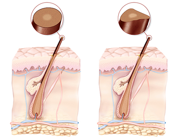 משמאל: שערה רגילה עם חתך עגול. מימין: שערה של ילד עם התסמונת, בעלת חתך משולש | Jacopin, Bsip, Science Photo Library