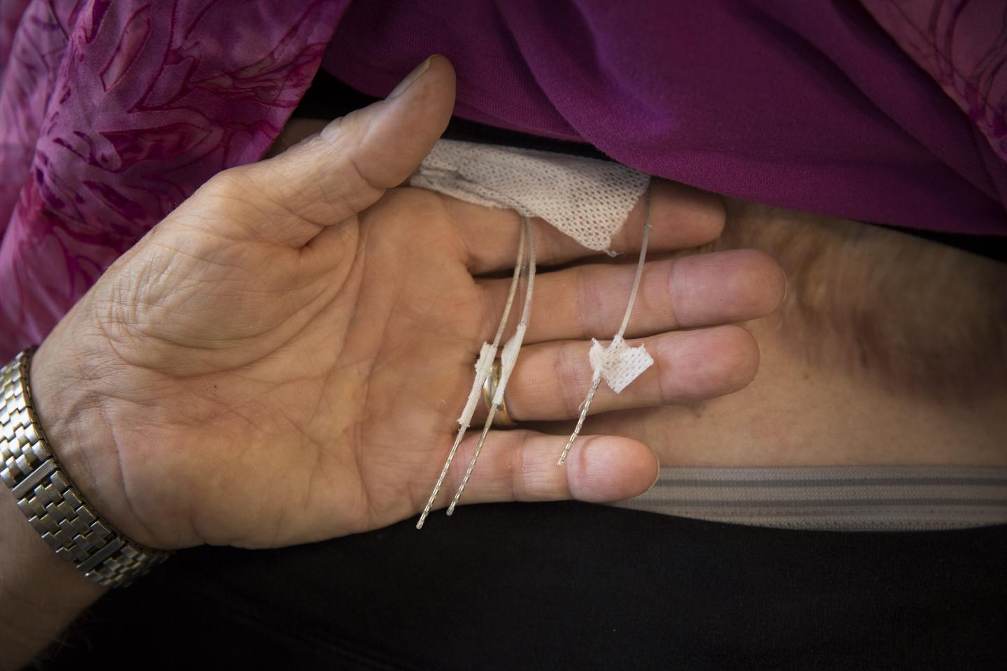 האלקטרודות המחוברות בניסוי ישירות לחוט השדרה | צילום: UPMC