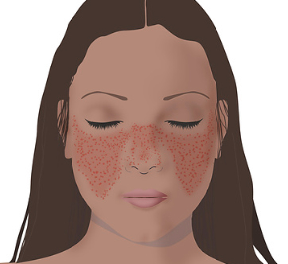 **תמונה של אישה עם פריחה על הפנים**