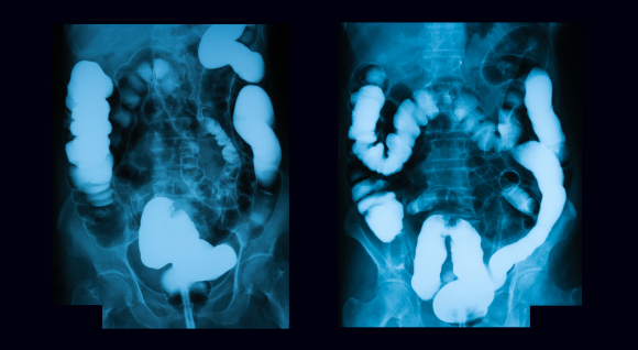 צילום רנטגן של מטופל עם סרטן המעי הגס | Shutterstock, Suttha Burawonk
