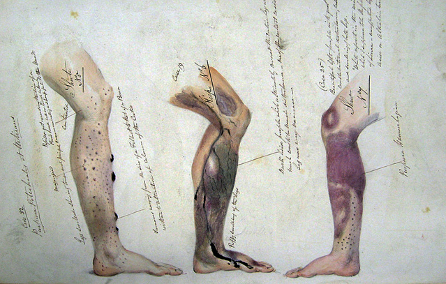 מחלה שקטלה מיליוני ימאים. איור ממחברתו של רופא בצי הבריטי במאה ה-19 | מקור: ויקיפדיה, נחלת הכלל