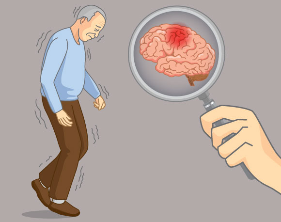 אדם הסובל מפרקינסון | איור: solar22, Shutterstock