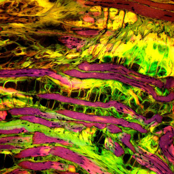 רקמת שריר של חולה ניוון שרירים במיקרוסקופ | מקור: Patrick Landmann, Science Photo Library