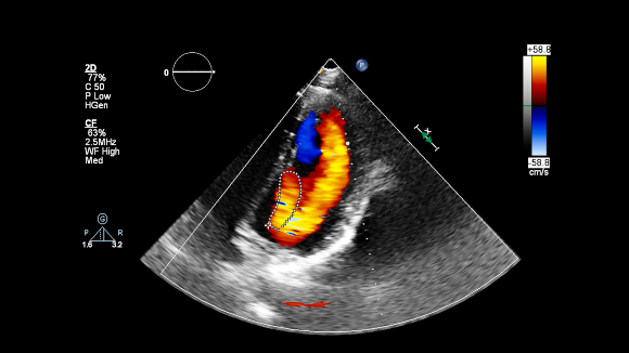 סריקת אולטרסאונד של הלב המראה בצבע את כיווני הזרימה של הדם בעזרת אפקט דופלר | צילום: faustasyan, Shutterstock
