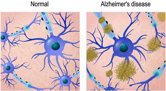 אילוסטרציה של תאי עצב במוח בריא (משמאל) ובמוח של חולה אלצהיימר, עם משקעי עמילואיד (בחום) | Shutterstock, Designua