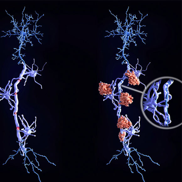 תא עצב בריא (משמאל) ותא עצב של חולה טרשת נפוצה, שתאי מערכת החיסון (באדום) תוקפים אותו ומסירים את ציפוי המיילין שעליו | Juan Gaertner, Science Photo Library