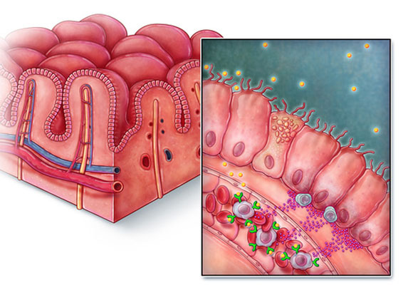 אילוסטרציה של תגובה חיסונית נגד גלוטן (בצהוב), אצל חולה צליאק | Evan Oto, Science Photo Library
