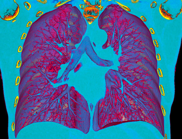 A CT scan enables the identification of pneumonia in a COVID-19 patient (the red spot left from the center of the image) | Source: VSEVOLOD ZVIRYK / SCIENCE PHOTO LIBRARY