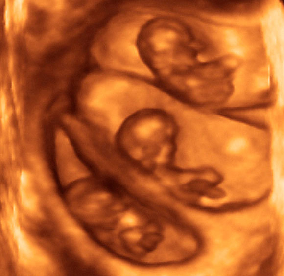 A common imaging method during pregnancy checkups. Three fetuses in the uterus are visible in a 3D ultrasound scan | Source: DR NAJEEB LAYYOUS / SCIENCE PHOTO LIBRARY