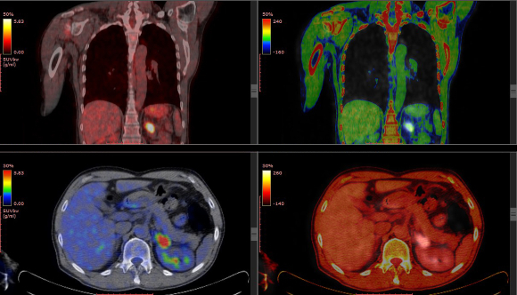 A radioactive scan enables the assessment of tissue function. PET scan of a patient’s torso, back view (top) and top view | Photo: springsky, Shutterstock