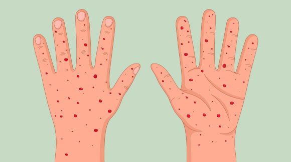 כפות ידיים עם פריחה של אבעבועות הקוף | איור: meandart, Shutterstock